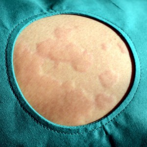 Skin rash, Urticaria, Allergic skin reaction.