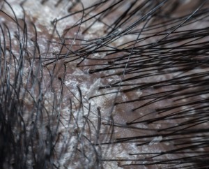 cuero-cabelludo-caspa-escamas-psoriasis_41043-2293