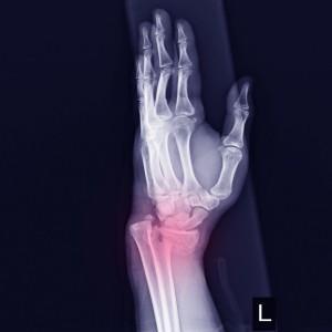 radiografia-articulacion-muneca-izquierda-fractura-desplazamiento-extremo-distal-radio-izquierdo_34251-167