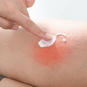 scratch-allergic-skin-from-mosquito-insect-bites-apply-medicine-cream_1962-991