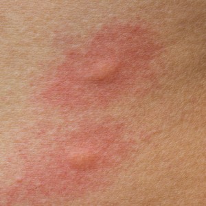 scratch-allergic-skin-from-mosquito-insect-bites_45334-25